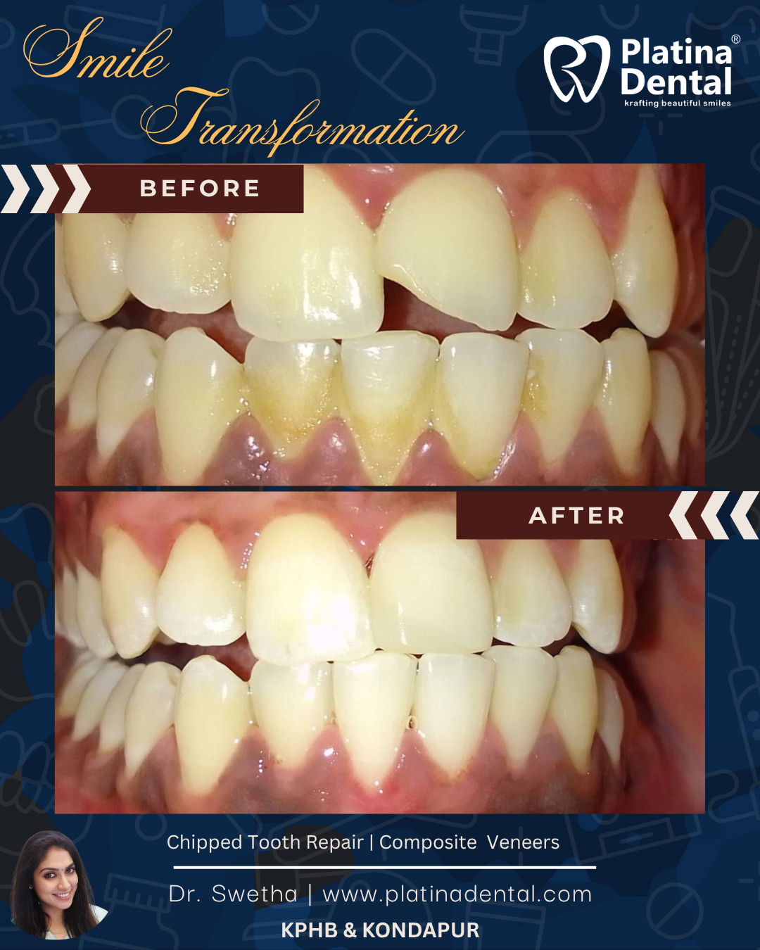 🦷 Chipped or Broken Front Tooth Repair in Hyderabad – Before & After by Dr. Swetha