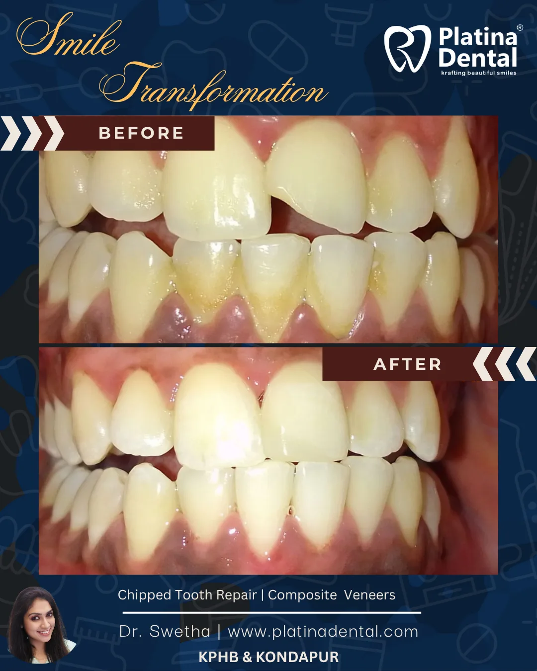 🦷 Chipped or Broken Front Tooth Repair in Hyderabad – Before & After by ...
