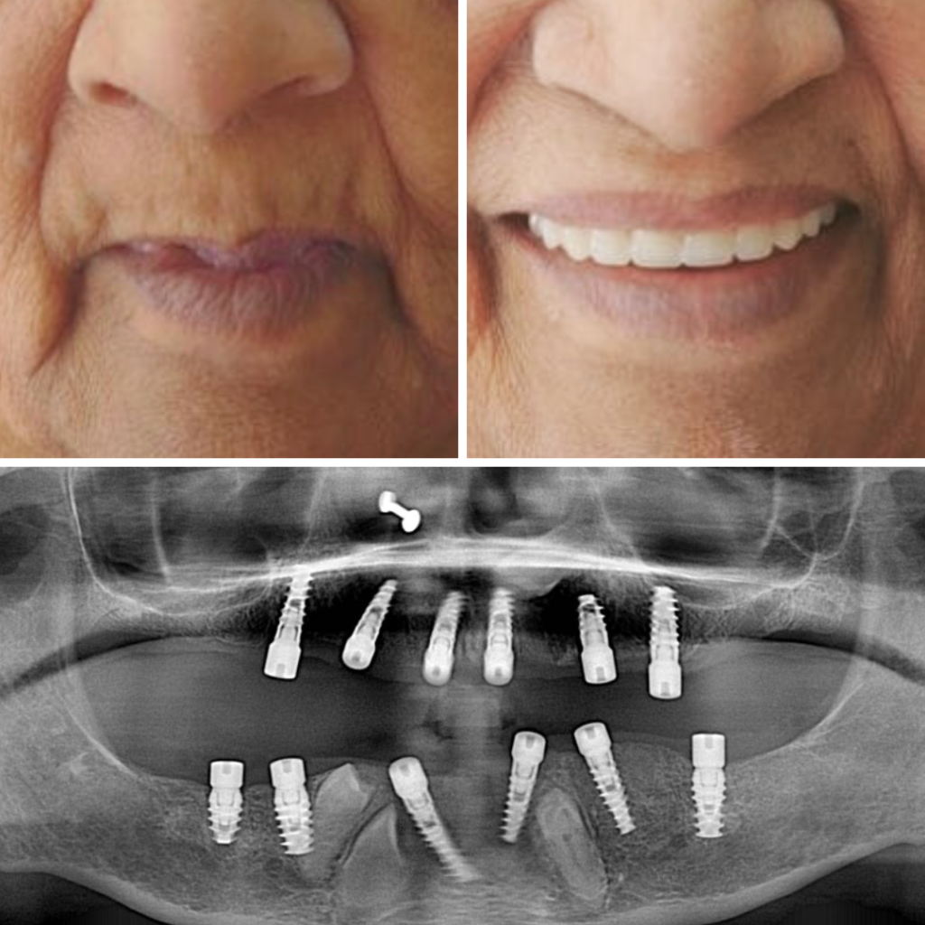 implants -2 implants 2