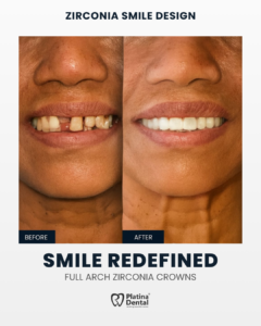 6 Essential Dental Tips for a Safer Holi and healthy smile by Dr. Swetha U 5 smile design zirconia crowns