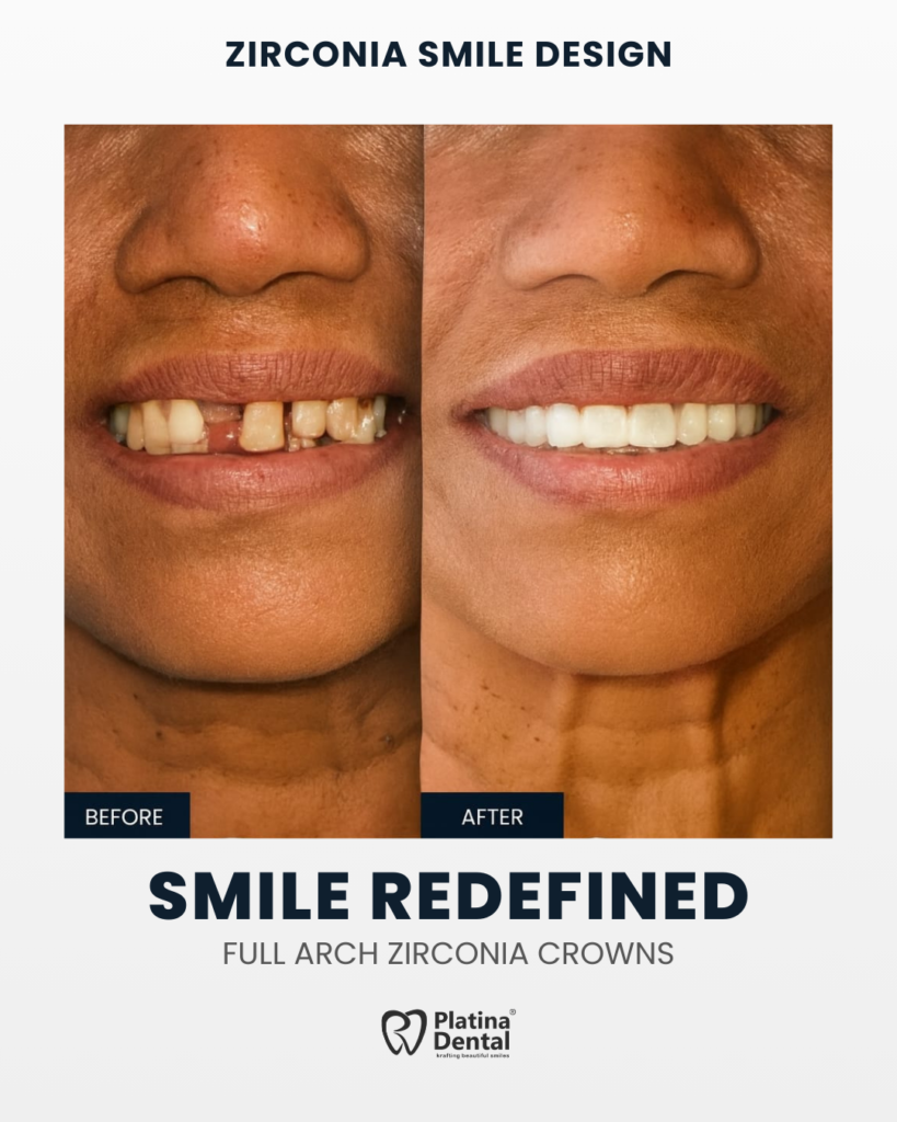 smile design zirconia crowns