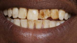 Fluorosis 4 fluorosis pt 1 b