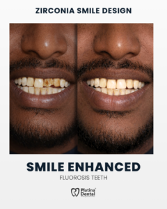 fluorosis teeth treatment before after hyderabad