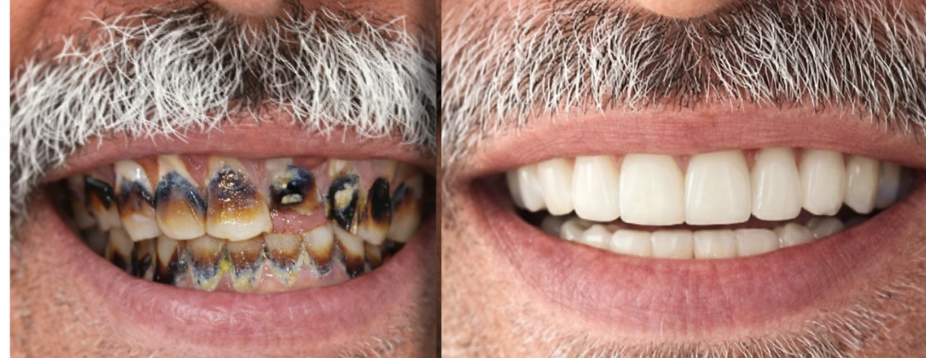 before after Full Mouth Rehabilitation in hyderabad
