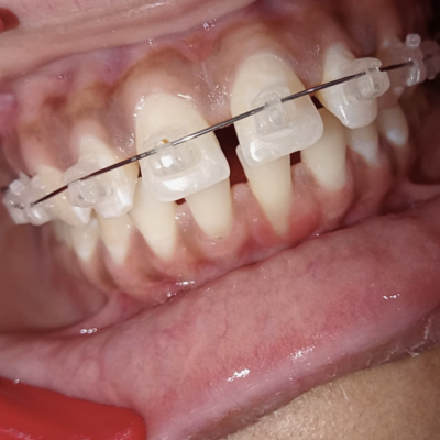 Ceramic Teeth Clips near me