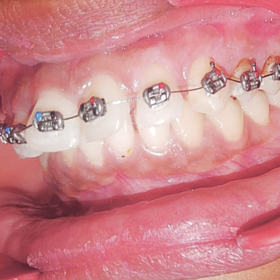 Metal Teeth Clips near me