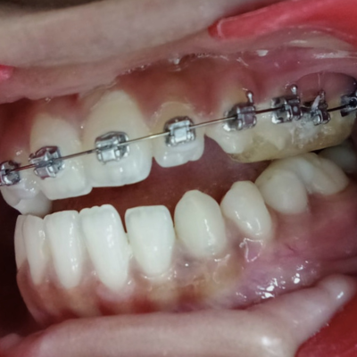 Self-Ligating Teeth Clips near me