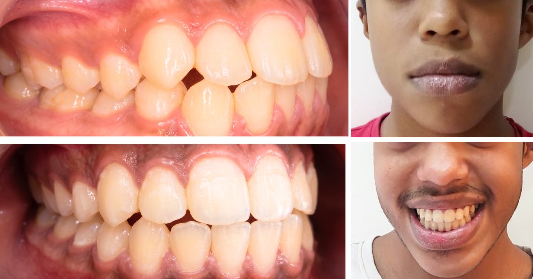 Front Protruded Teeth Correction with Self-Ligating Metal Teeth Clips with Chin Cup