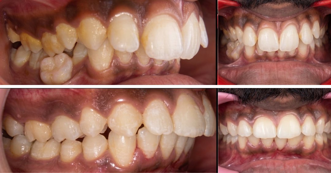 Proclinated & Crooked Teeth Correction with Self-Ligating Metal Teeth Clips