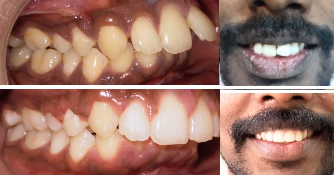 Front Protruding Teeth & Teeth Gap Correction with Metal Teeth Clips