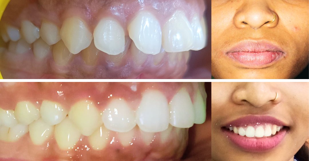 invisalign cost in kondapur before and after results at Platina Dental Kondapur