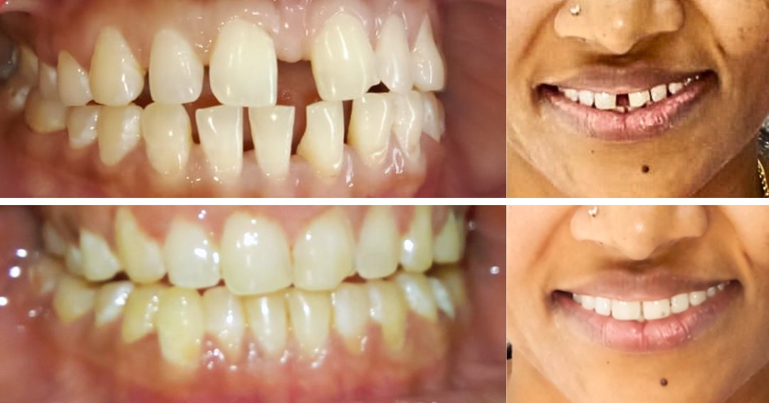 invisalign near me before and after results at Platina Dental Kondapur