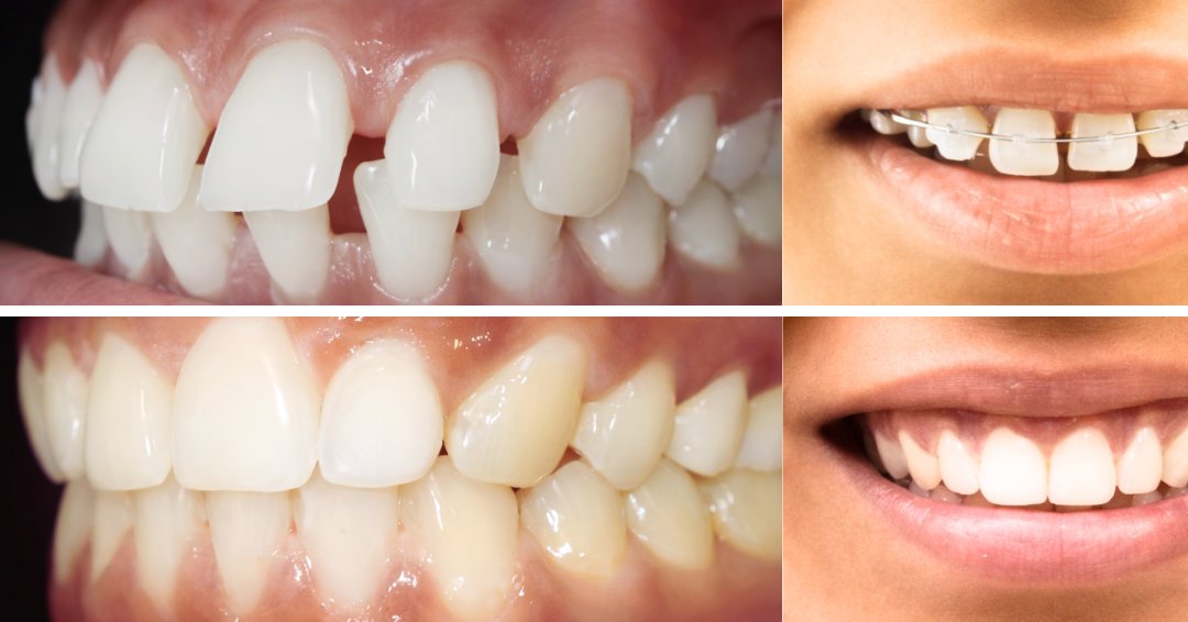 Smile Enhancement with Teeth Gap and Protruding teeth correction  with Ceramic Teeth Clips