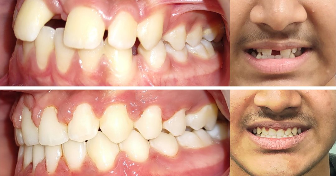 Protruding Teeth, Midline Diastema and Teeth Gaps Correction with Damon Teeth Clips
