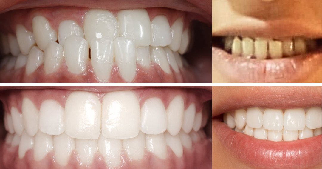 Under-Bite and Crooked Teeth Correction with Self-Ligating Metal Teeth Clips